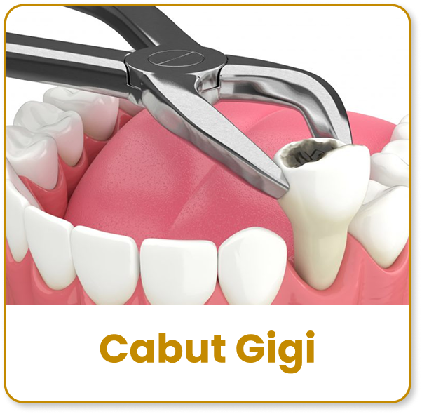 cabut gigi