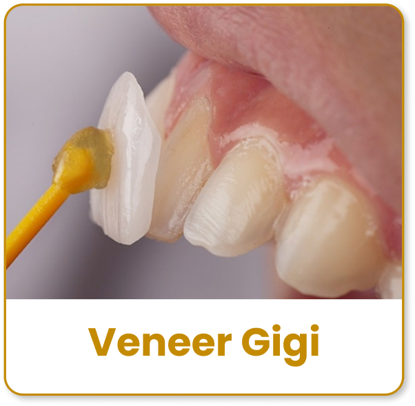veneer